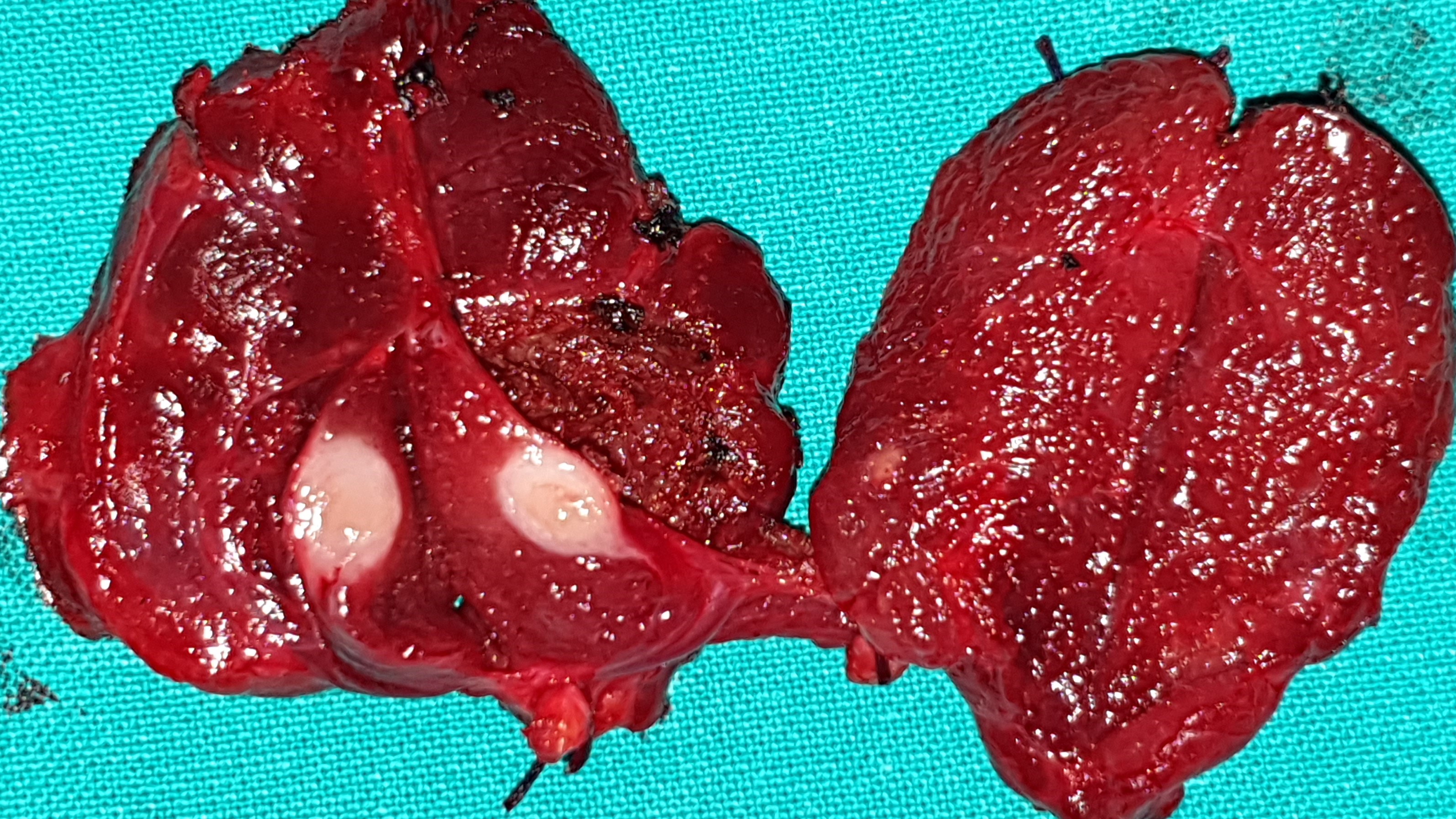 PAPILLARY THYROID CARCINOMA