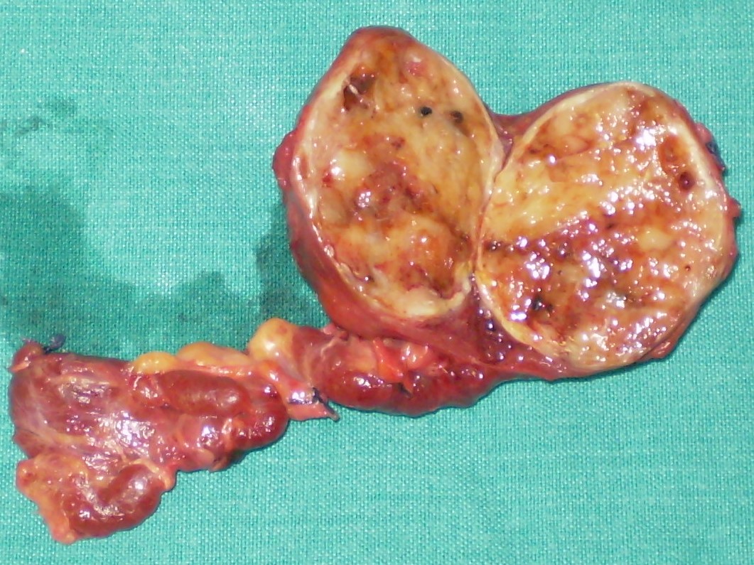PAPILLARY THYROID CARCINOMA
