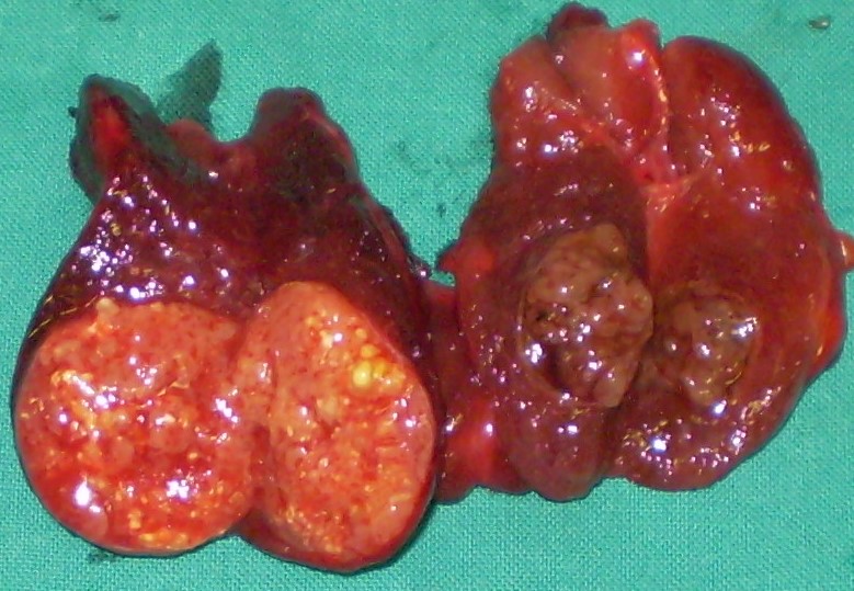 PAPILLARY THYROID CARCINOMA
