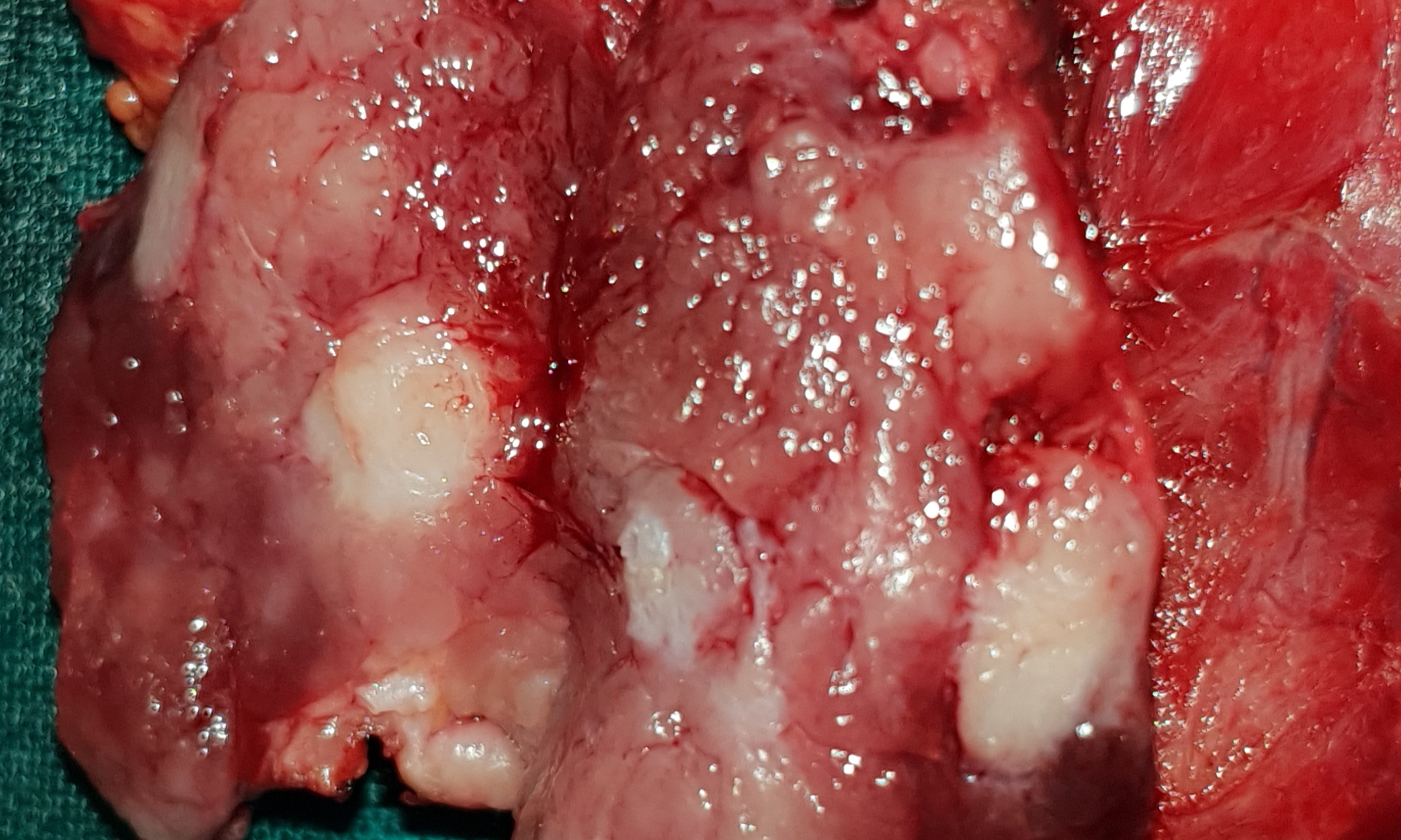 PAPILLARY THYROID CARCINOMA