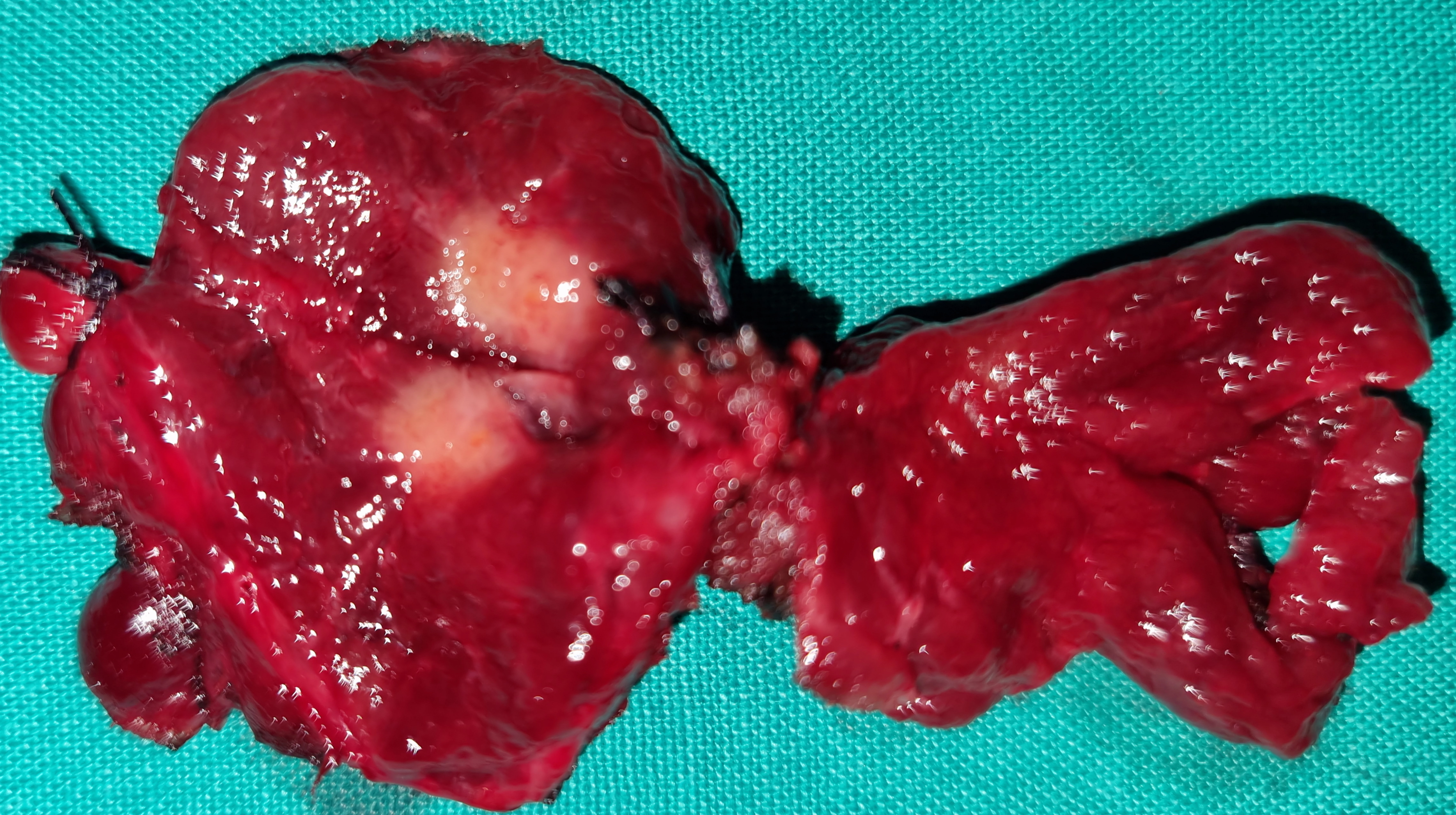 PAPILLARY THYROID CARCINOMA