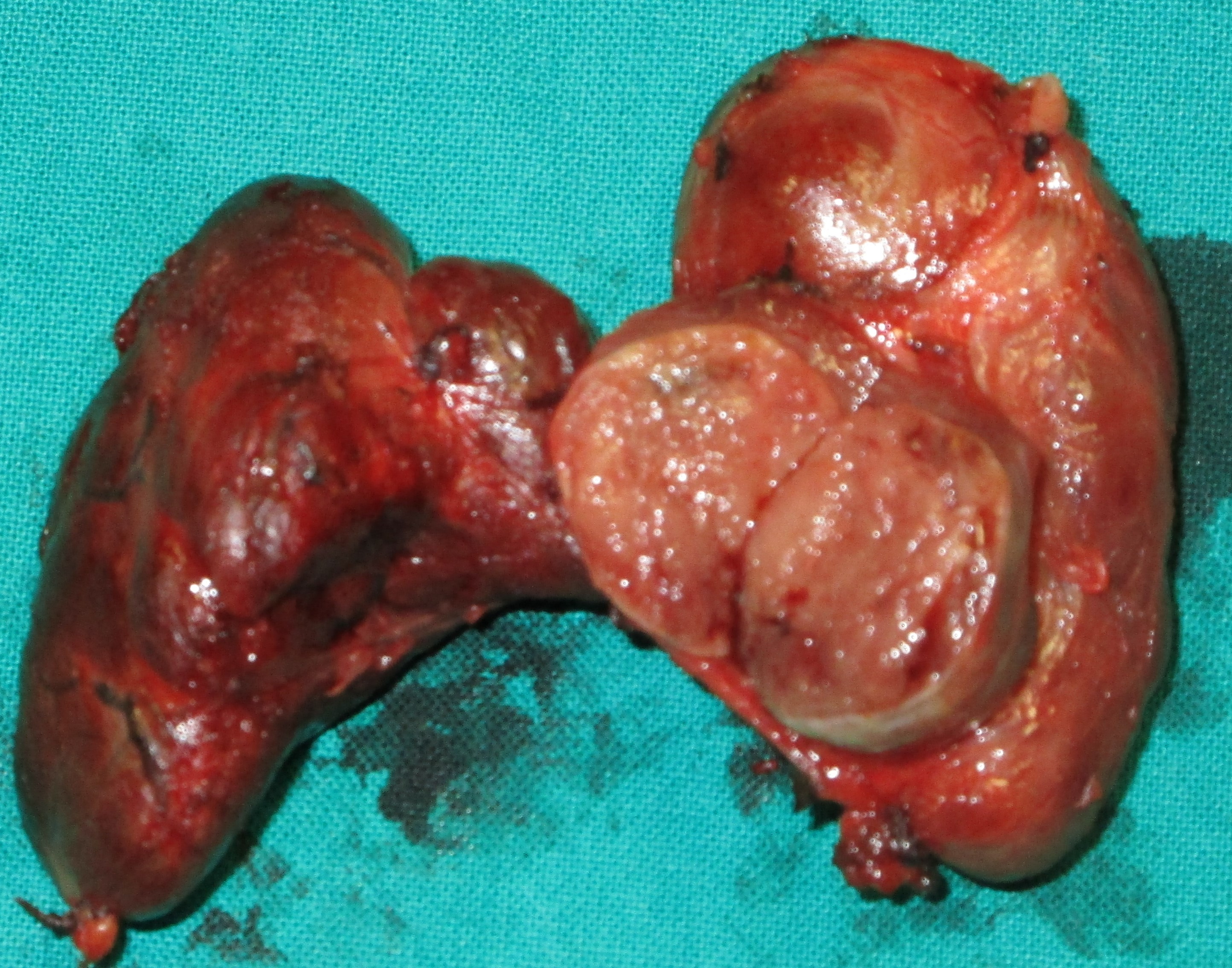PAPILLARY THYROID CARCINOMA
