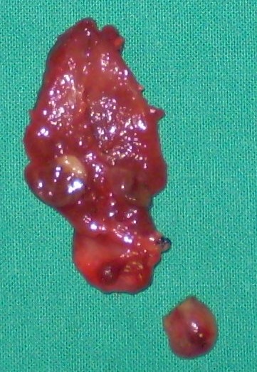 PAPILLARY THYROID CARCINOMA + PARATHYROID ADENOMA