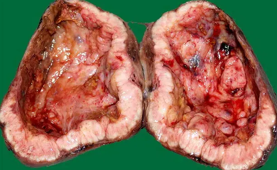 PAPILLARY CARCINOMA