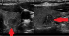 PAPILLARY THYROID CARCINOMA