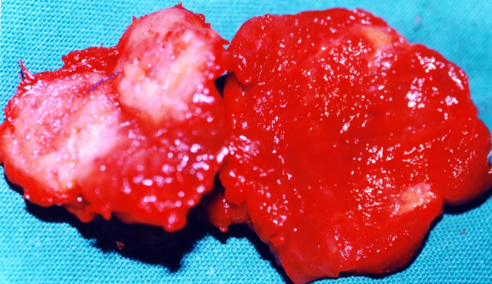 PAPILLARY THYROID CARCINOMA