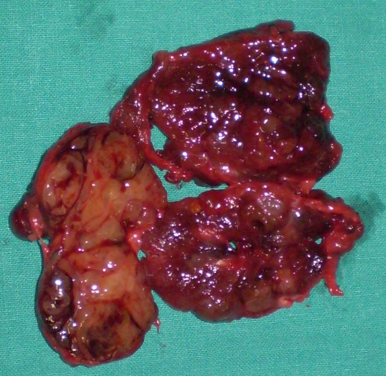 BENIGN THYROID NODULE