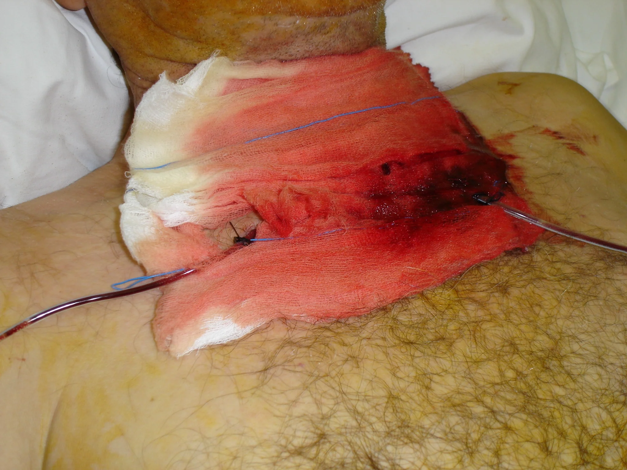 POSTOPERATIVELY BLOCKED DRAINS