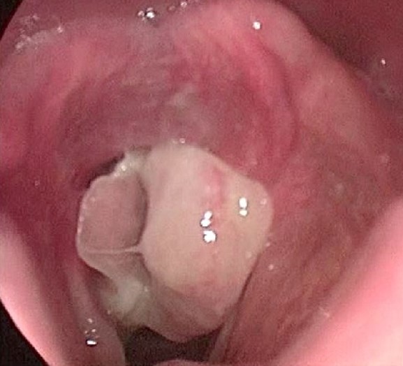 POST INTUBATION GRANULOMA