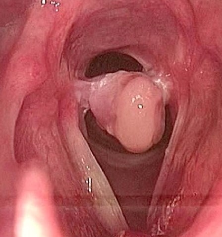 POST INTUBATION INTER-ARYTENOID ADHESION
