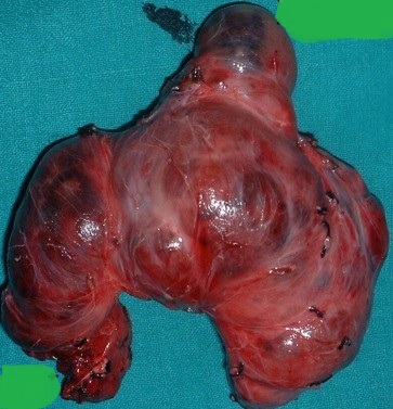 PROMINENT PYRAMIDAL THYROID LOBE