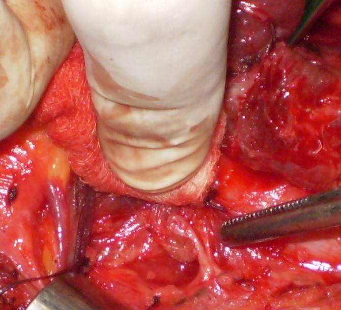 INFERIOR RECURRENT LARYNGEAL NERVE