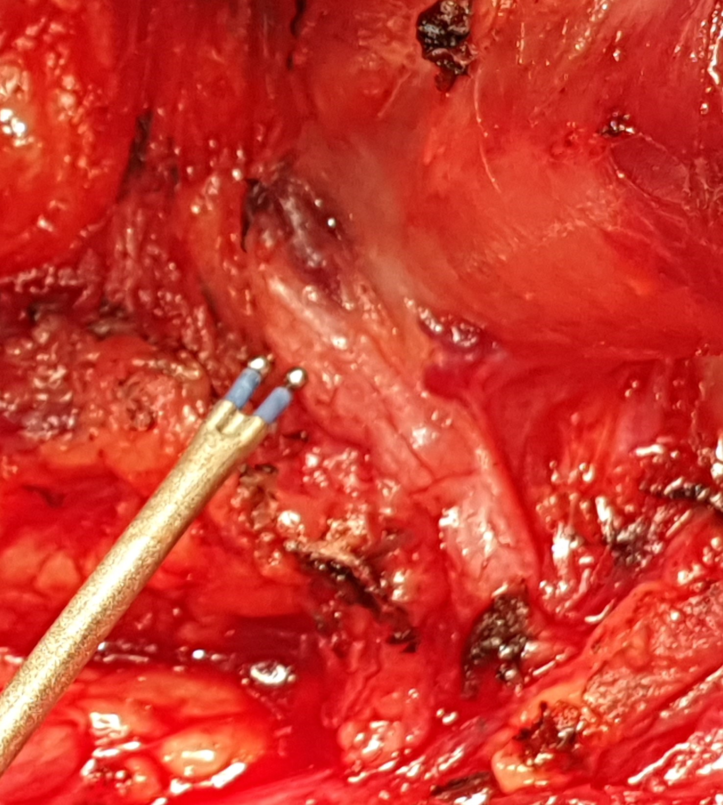 INFERIOR RECURRENT LARYNGEAL NERVE