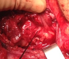 INFERIOR RECURRENT LARYNGEAL NERVE