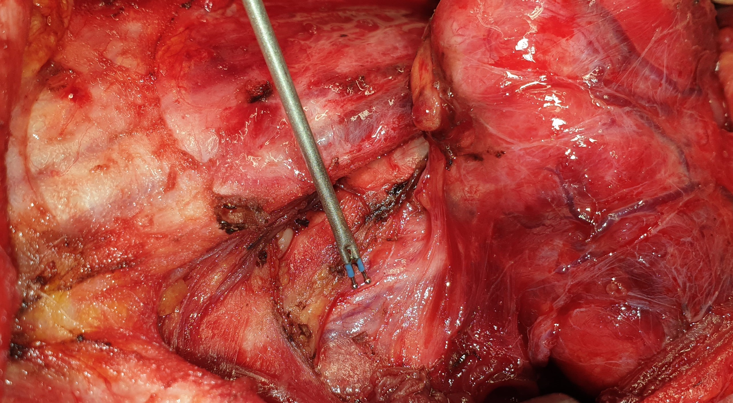 INFERIOR RECURRENT LARYNGEAL NERVE