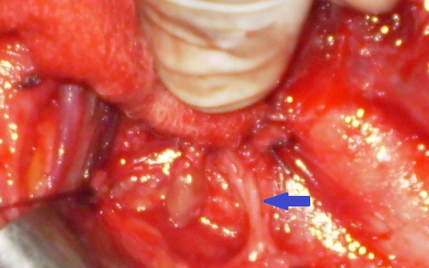 INFERIOR RECURRENT LARYNGEAL NERVE