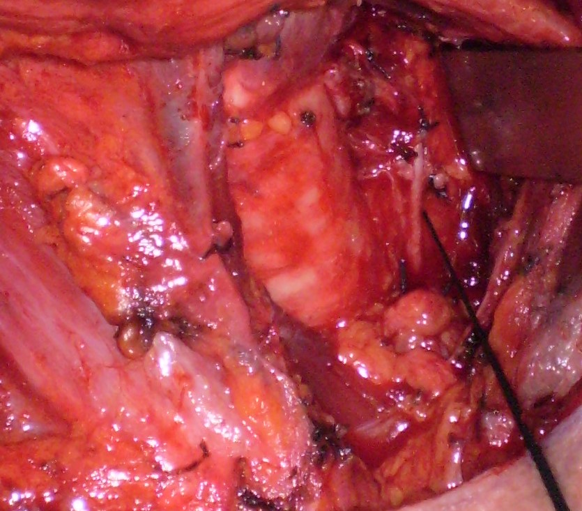 INFERIOR RECURRENT LARYNGEAL NERVE