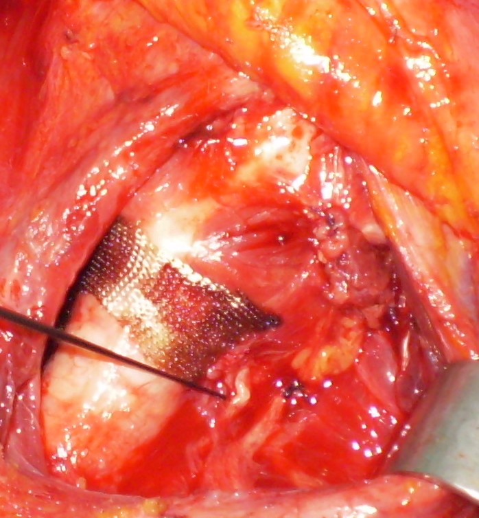 INFERIOR RECURRENT LARYNGEAL NERVE