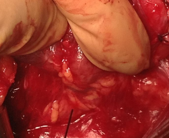 INFERIOR RECURRENT LARYNGEAL NERVE