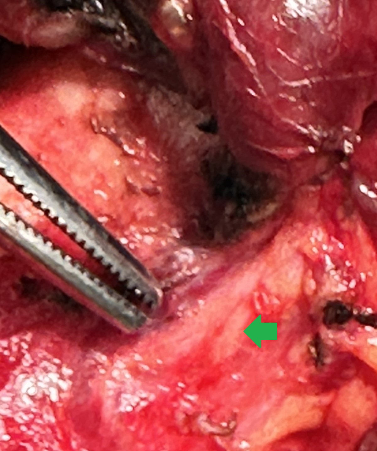 INFERIOR RECURRENT LARYNGEAL NERVE