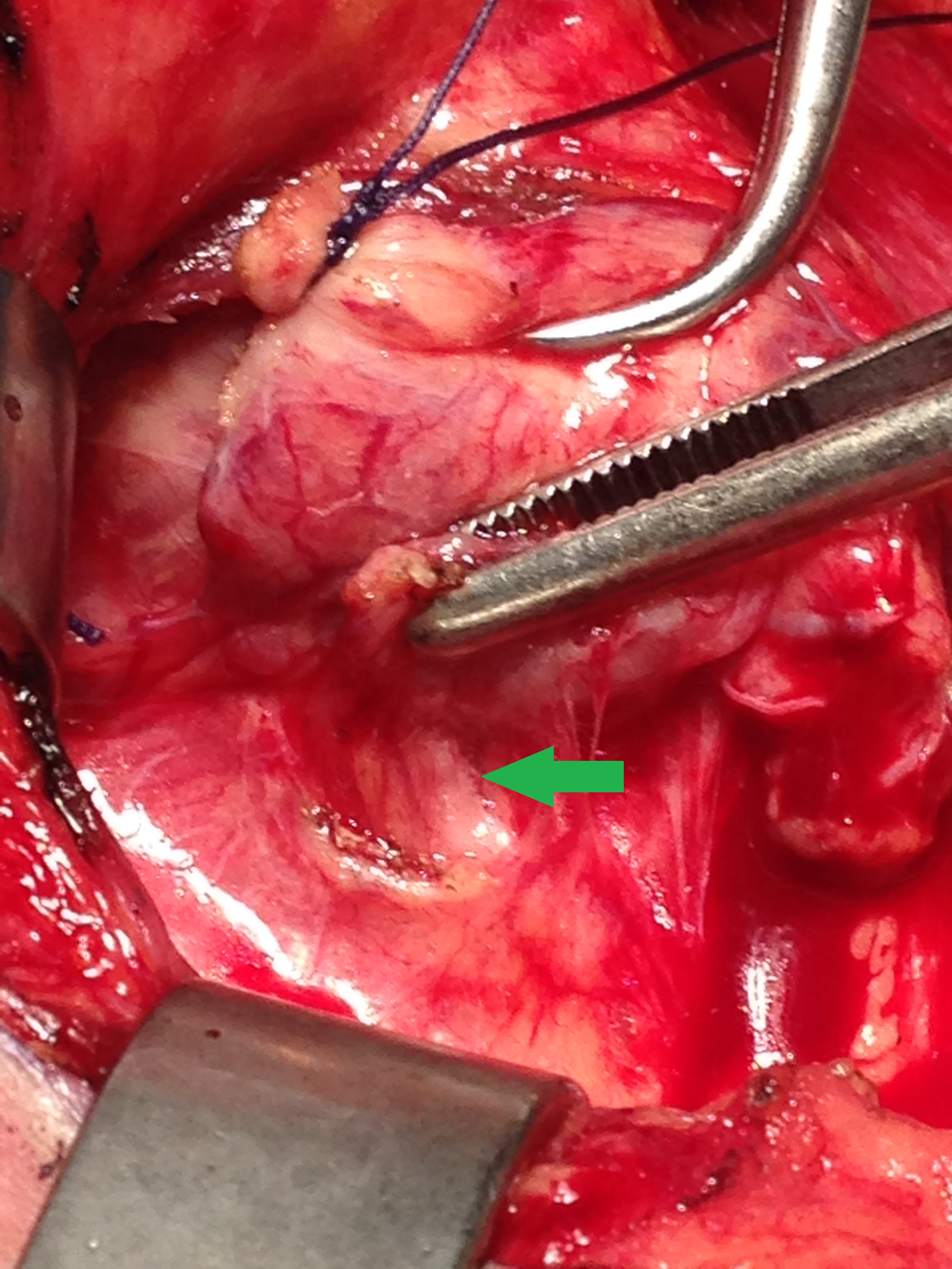 INFERIOR RECURRENT LARYNGEAL NERVE