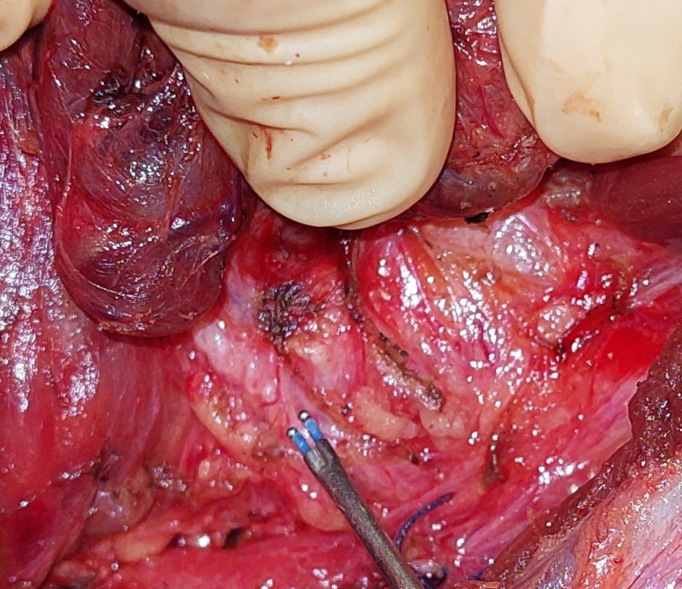 INFERIOR RECURRENT LARYNGEAL NERVE