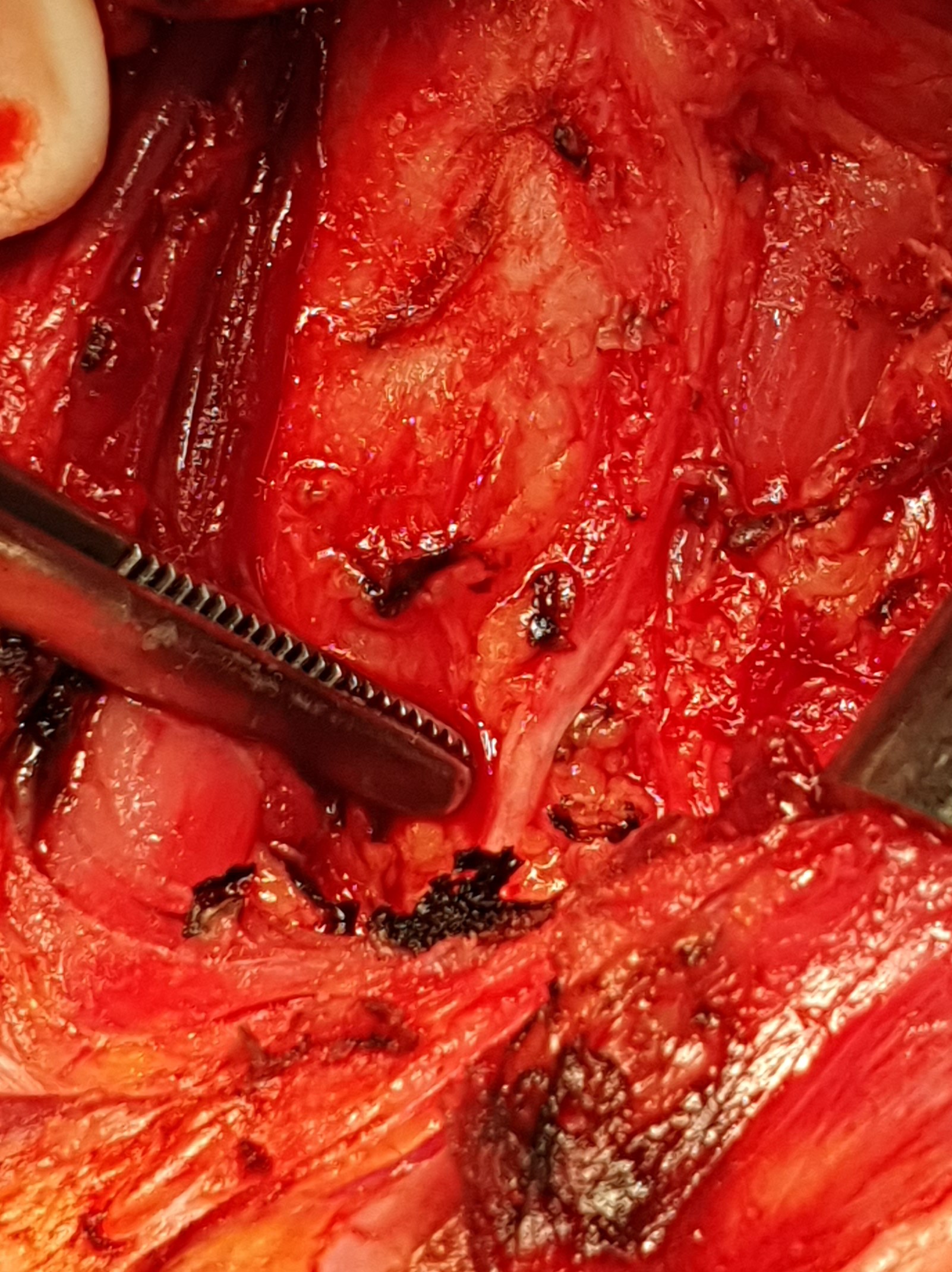 INFERIOR RECURRENT LARYNGEAL NERVE