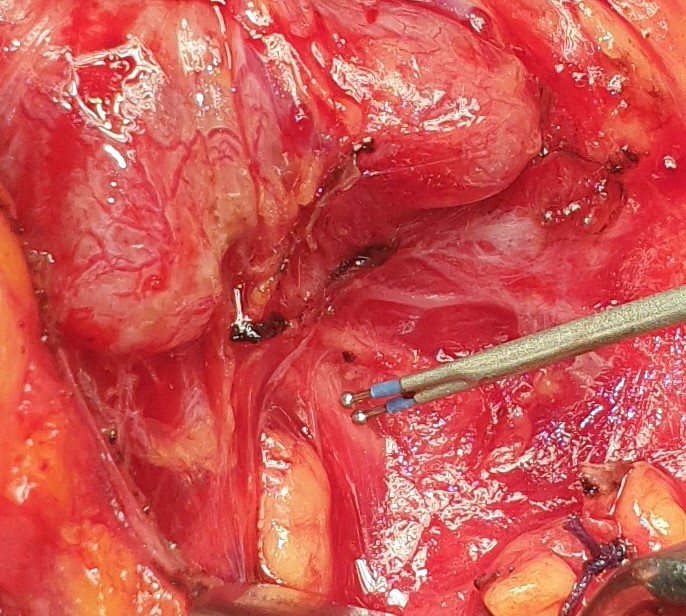 INFERIOR RECURRENT LARYNGEAL NERVE