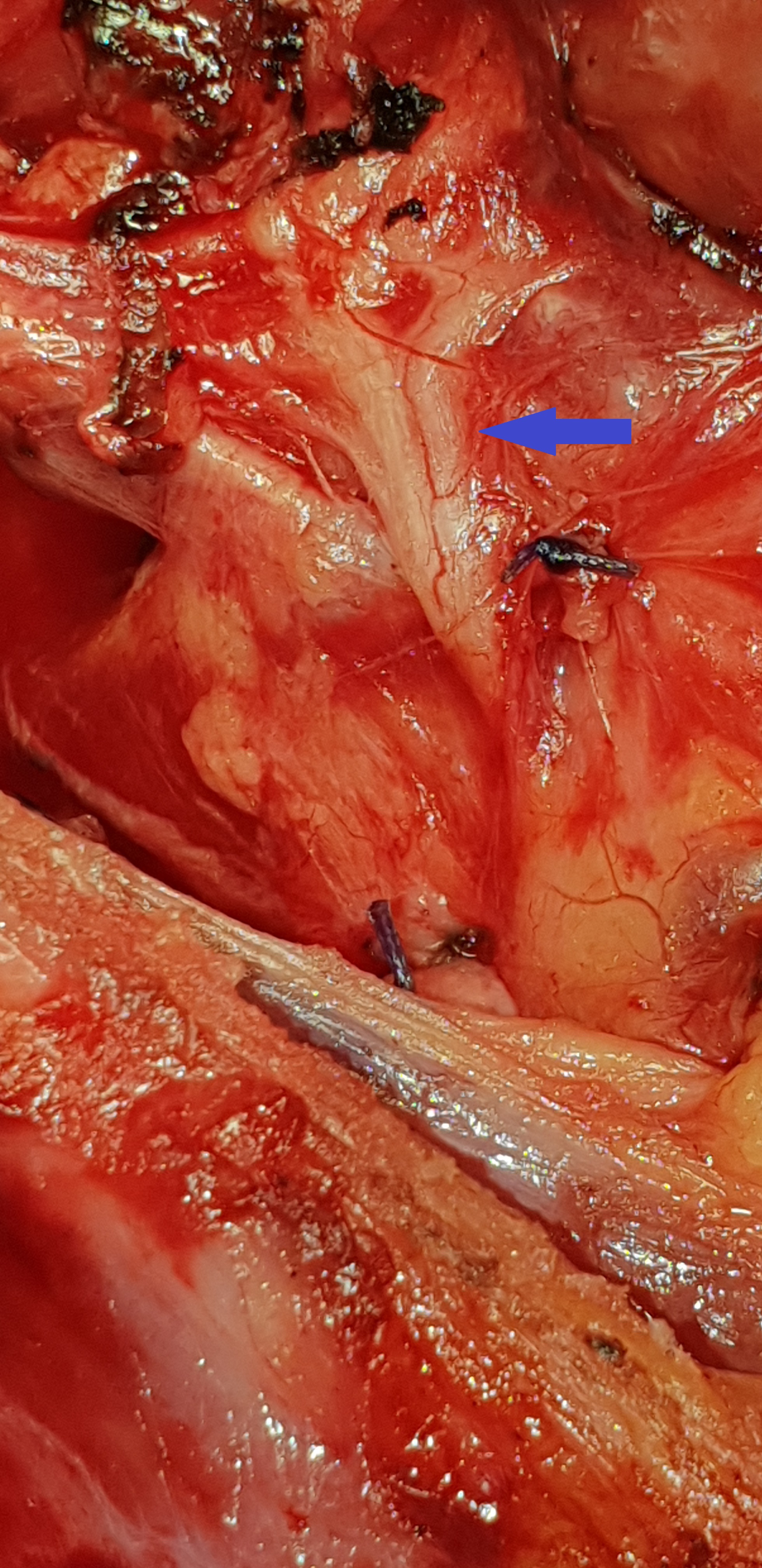 INFERIOR RECURRENT LARYNGEAL NERVE