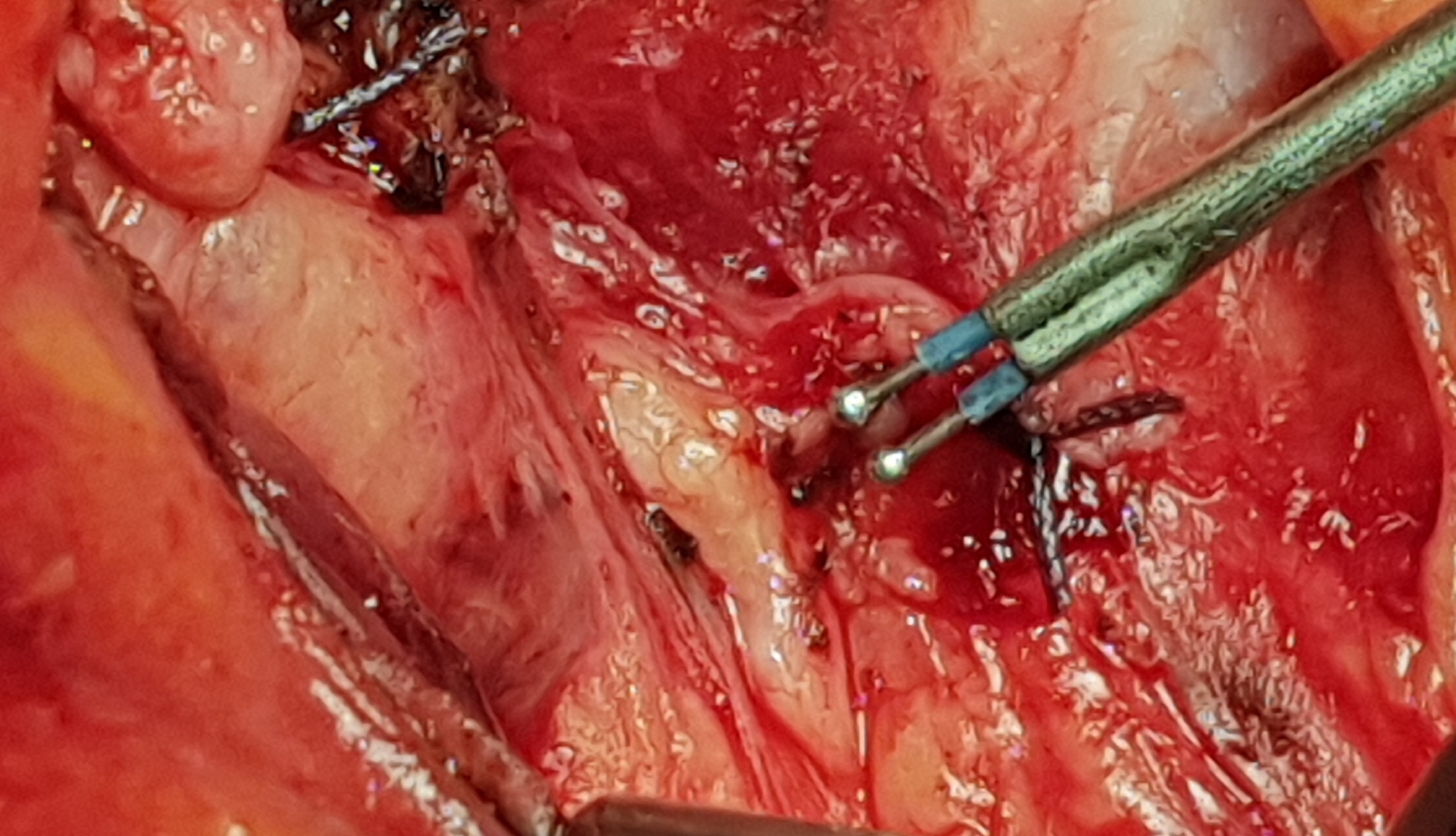 INFERIOR RECURRENT LARYNGEAL NERVE