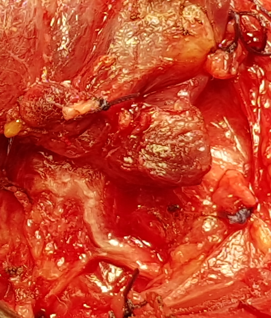 INFERIOR RECURRENT LARYNGEAL NERVE