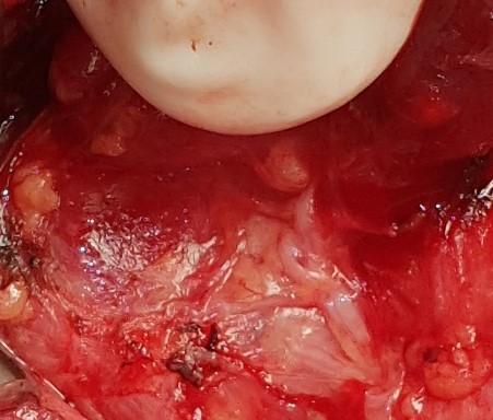 INFERIOR RECURRENT LARYNGEAL NERVE