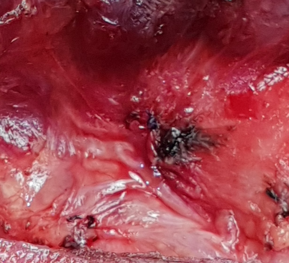 INFERIOR RECURRENT LARYNGEAL NERVE