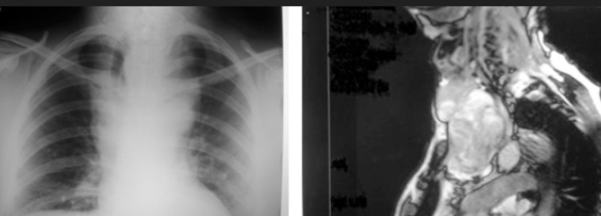 RETROSTERNAL GOITER