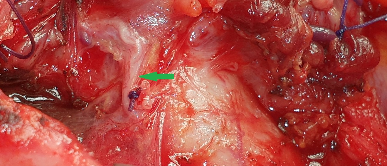 RIGHT INFERIOR RECURRENT LARYNGEAL NERVE