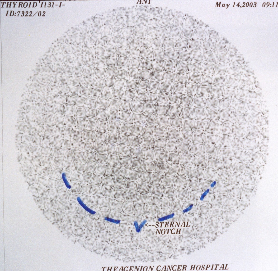 THYROID SCAN POST-THYROIDECTOMY