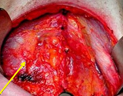 SQUAMOUS CELL THYROID CARCINOMA
