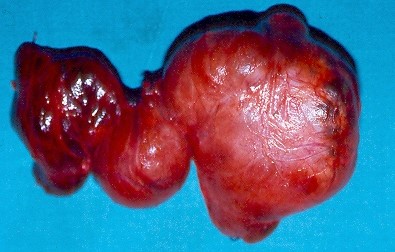 THYROID GOITER