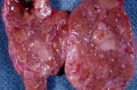 THYROID LYMPHOMA