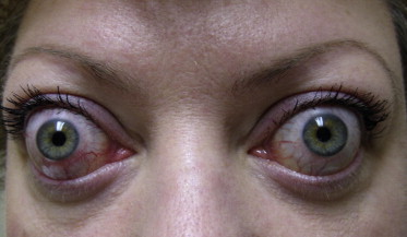THYROID OPTHALMOPATHY