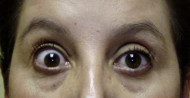 THYROID OPTHALMOPATHY
