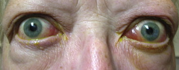 THYROID OPTHALMOPATHY