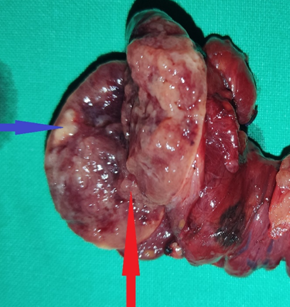 PAPILLARY AND FOLLICULAR THYROID CARCINOMAS