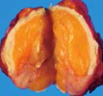 THYROID TERATOMA