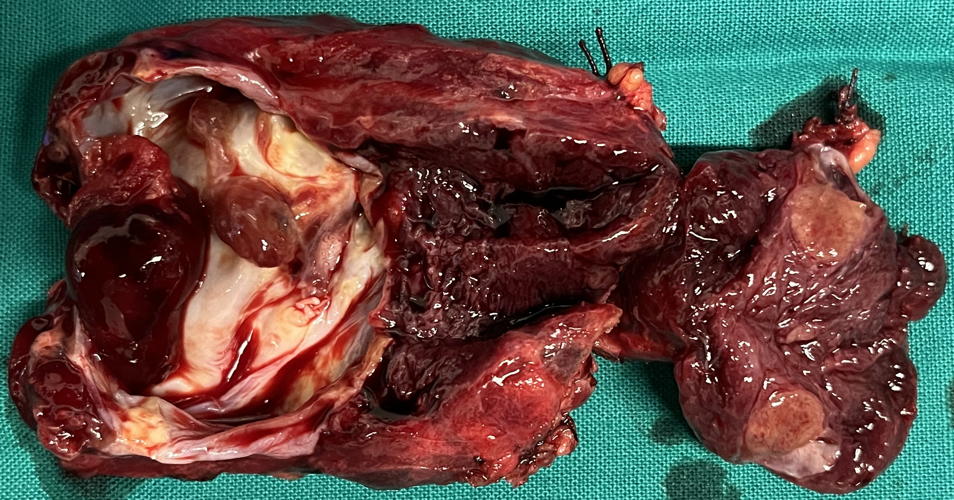 TOXIC GOITER