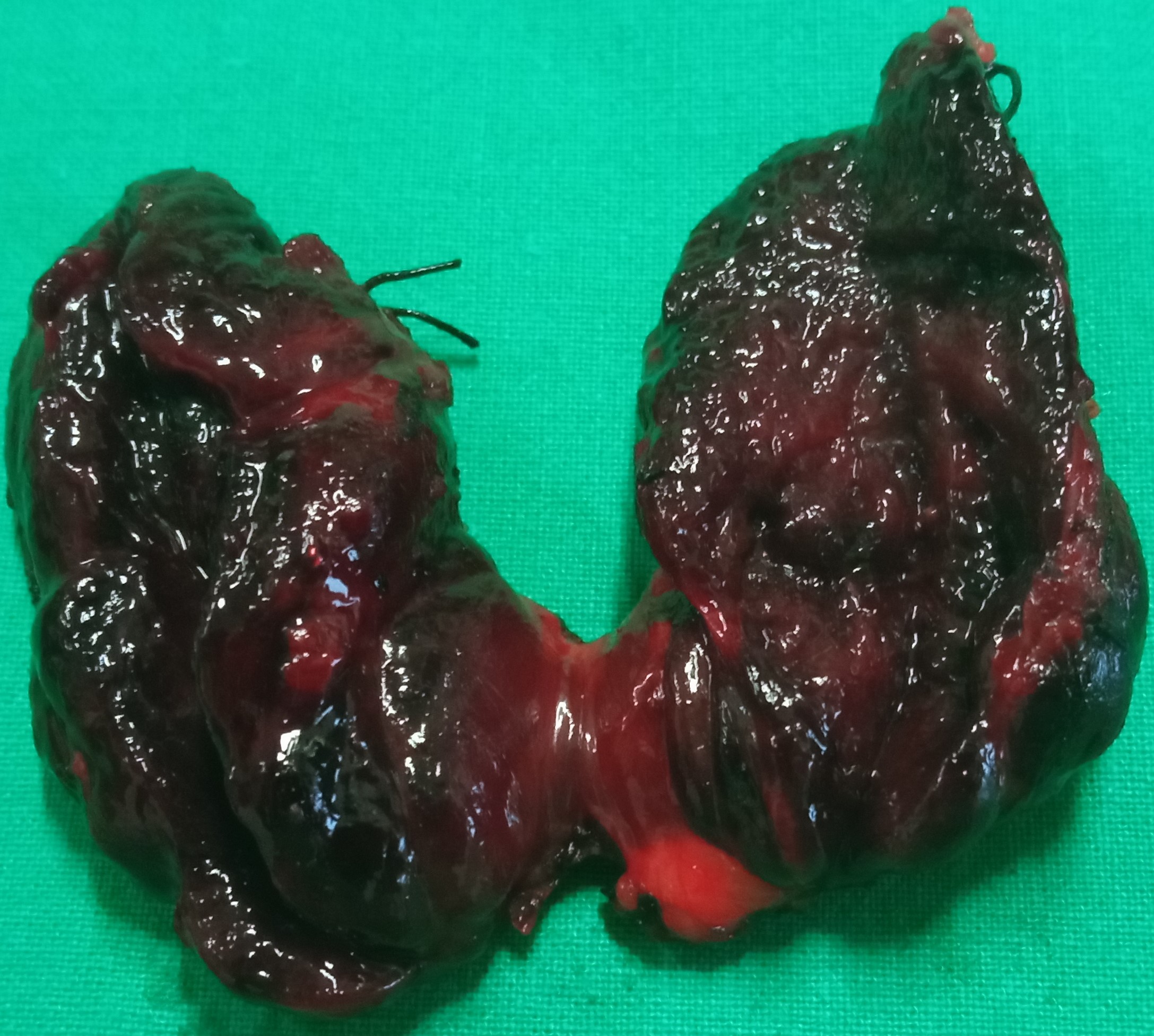 TOXIC THYROID GOITER