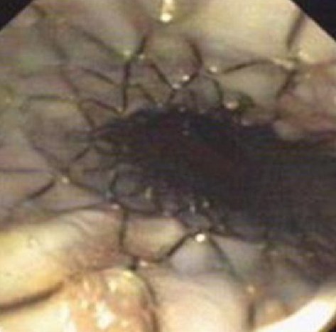 TRACHEOMALACIA - STENT