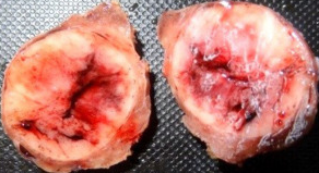 WARTHIN LIKE VARIANT PAPILLARY THYROID CARCINOMA