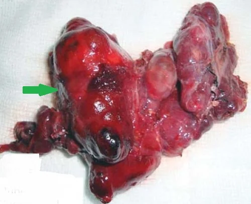 ZUCKERKANDL TUBERCLE