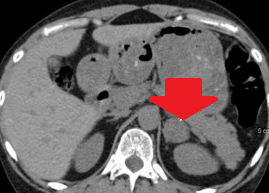 ADRENAL ADENOMA